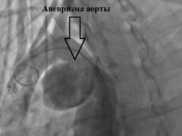 Аневризма аорты.
