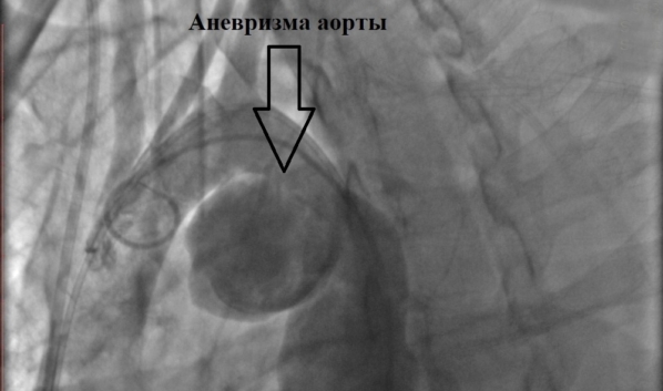Аневризма аорты.
